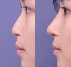 北京假体隆鼻一般要多少钱