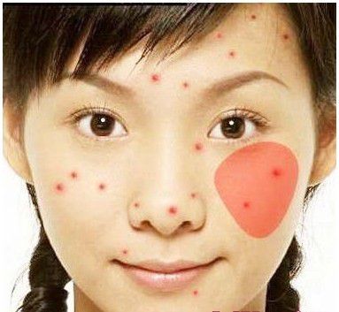 【美容护肤】脸上长痘部位对应的身体问题