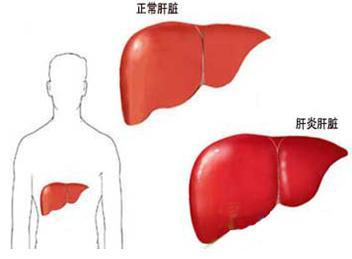 慢性丙型病毒性肝炎临床辩治经验