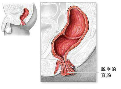 脱肛了缩不回去怎么办