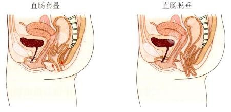 脱肛怎样治疗?