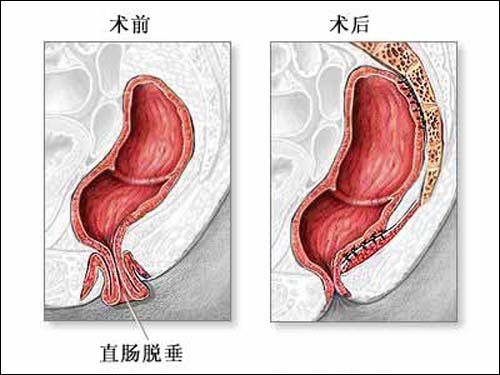 脱肛怎样治疗