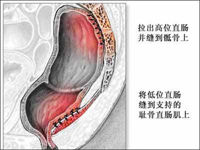 脱肛了缩不回去怎么办