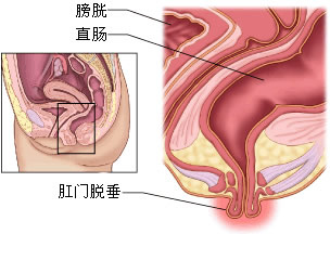 脱肛了缩不回去怎么办