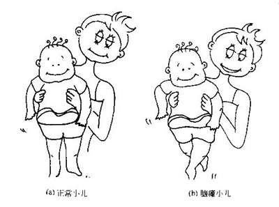 小儿脑瘫肌张力检查很重要