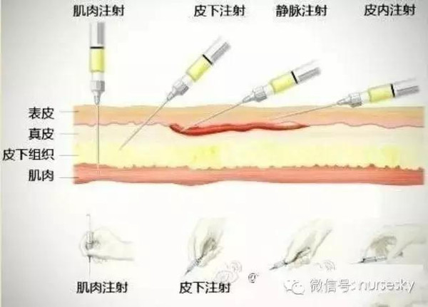 >> 三,常用注射法  列表比较4种常用注射法的不同答:一,肌肉注射