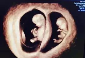双胎是试管婴儿的最佳选择吗?