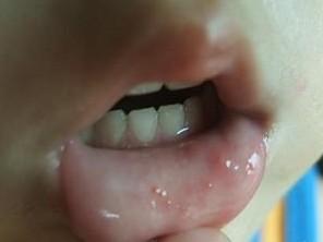 该病与手足口病相似,也是口腔及喉咙还有舌下起似针点般的疱疹溃疡,但