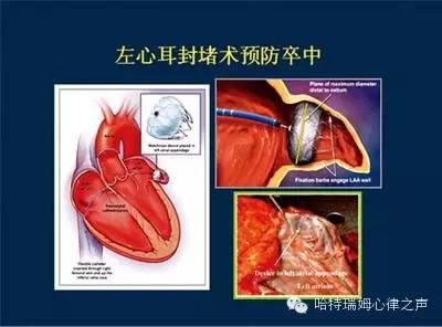 房颤卒中预防之左心耳封堵