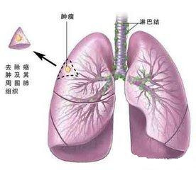 如何筛查肺癌高危人群--胸部低剂量螺旋CT