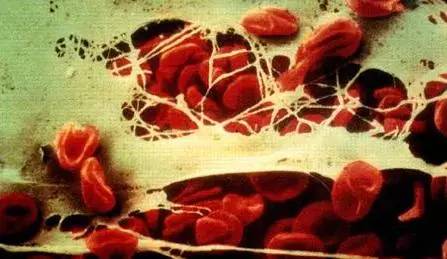 血小板低到什么程度会导致出血危险