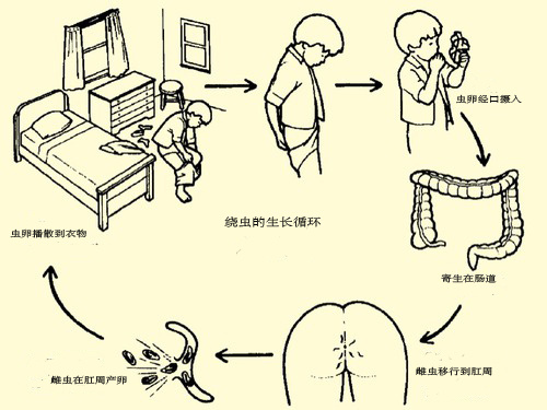 小孩夜间肛周瘙痒史强烈提示绕虫感染.