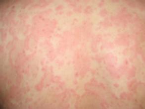 如何预防过敏性荨麻疹的发生