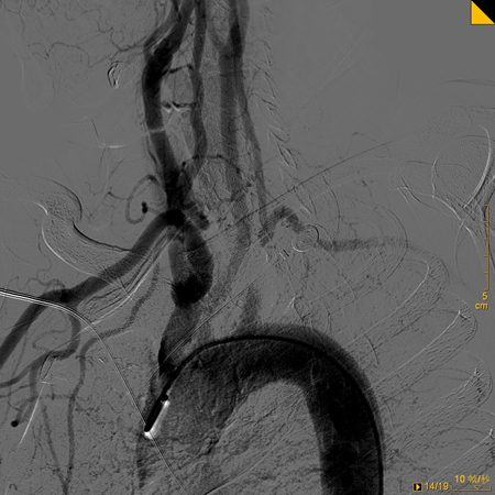 图为血管造影显示左锁骨下动脉闭塞