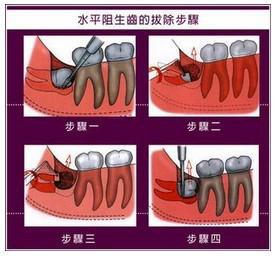 阻生齿:通常这是最讨厌的一种,牙医会觉得很难搞掂,但病人却不一定有