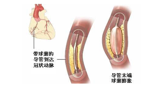 急性心肌梗死要尽快进行介入治疗