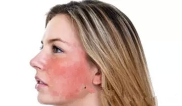 朵嘉浓激素脸:糖皮质激素对皮肤造成的危害