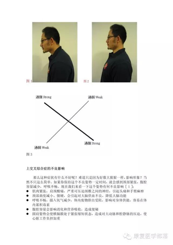 针对上交叉综合症的实用训练方法