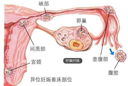 宫外妊娠--卵巢妊娠