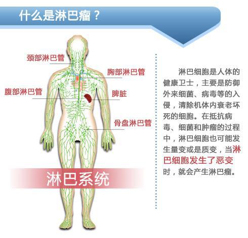 世界淋巴瘤日淋巴瘤过半可痊愈哪些征兆最需警惕