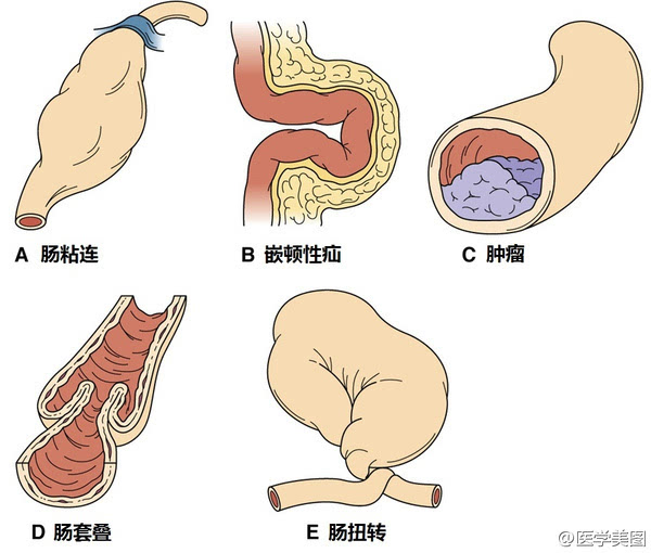 消化道肿瘤多会引起肠梗阻心脏支架对大众来说耳熟能详,而肠道里放