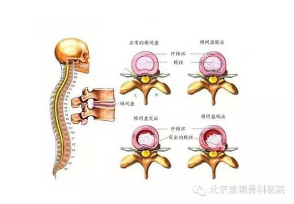 你知道腰椎间盘突出与膨出的区别吗?