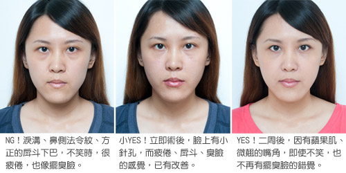 整牙整出戽斗脸