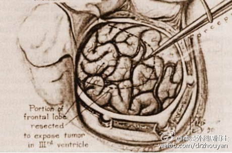 (图示:dandy于1933年介绍了"后方经胼胝体入路"切除三脑室病变.