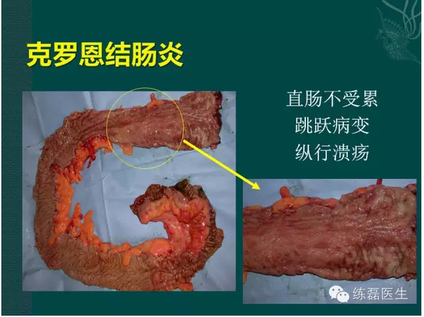 结肠克罗恩病的外科治疗