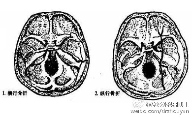 【6. 外伤性听神经损害】:多由外伤引起,常合并岩骨骨折.