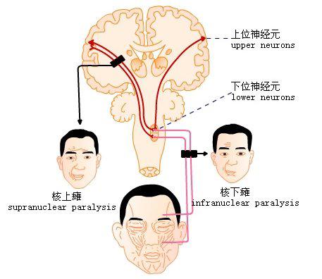 周围性面瘫