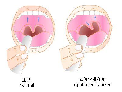 舌咽神经检查 检查时嘱病人张口,先观察腭垂是否居中,两侧软腭高度