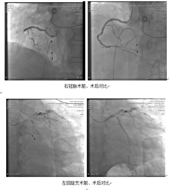 右冠脉术前,术后对比 左回旋支术前,术后对比