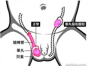 男人隐睾怎么办