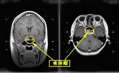 颅咽管瘤和垂体瘤的区别在哪里?