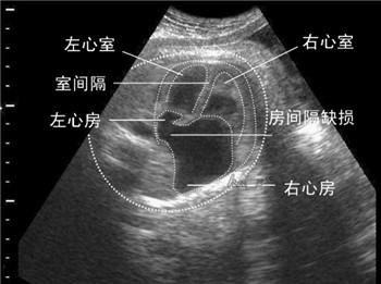 孕4月胎儿现缺陷,服堕胎药后子宫内奇迹震惊医生