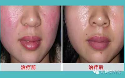 红血丝是怎样形成的 怎么治疗红血丝