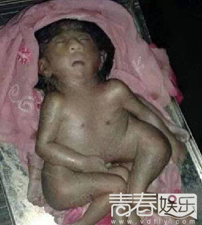 出生一个单只眼睛的女婴,帮助接生的医疗人员认为这个畸形婴儿是