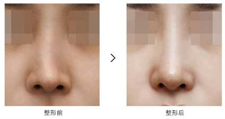 人口鼻感染_预防人口密集感染(3)