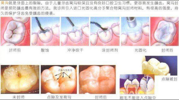 孩子蛀牙都是父母的错,为啥不带娃去做窝沟封