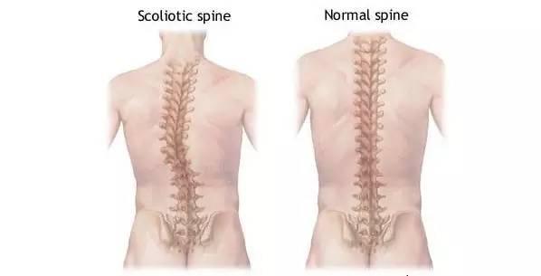 脊柱侧凸通常发生于颈椎,胸椎或胸部与腰部之间的脊椎,也可以单独发生
