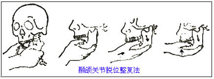 下颌骨脱臼怎么办