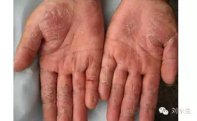 因此,手部湿疹有其易发人群:经常接触洗衣液,洗洁精等洗涤剂的家庭