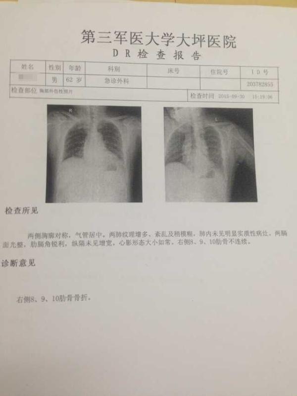 网友所发第三军医大学大坪医院检查报告显示,62岁的熊某某右侧8,9,10