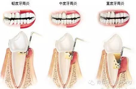 牙周炎进一步发展会出现牙齿松动,牙周脓肿.