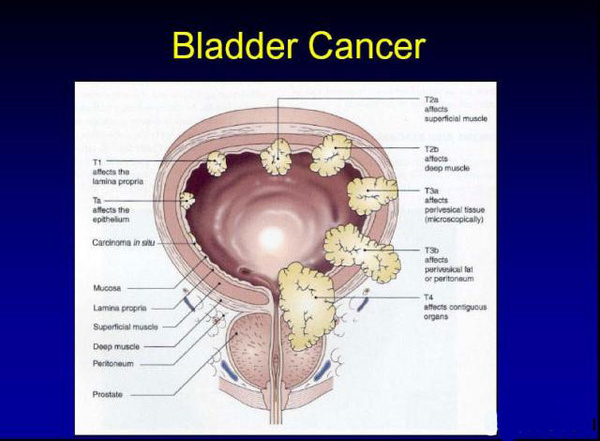 膀胱癌