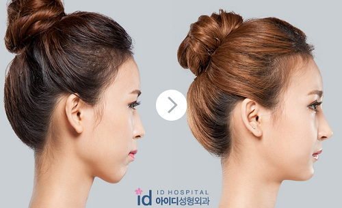 韩国id解析 凸嘴手术需要选择正确的方法