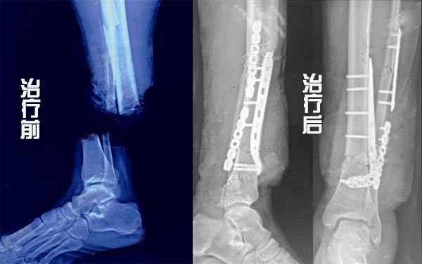 真人版绝境求生 硬汉腿断冷静自救