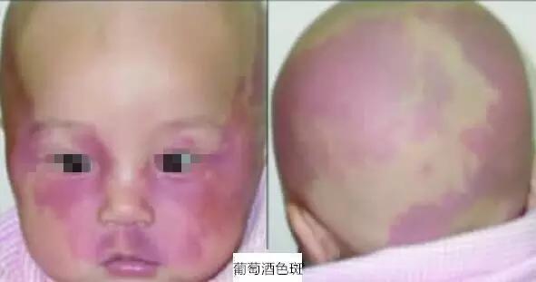 2,葡萄酒色斑