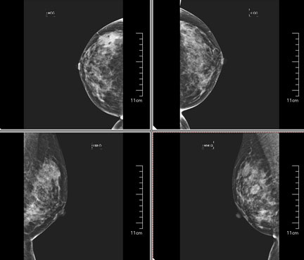 低剂量乳腺钼靶x线摄影技术的探讨